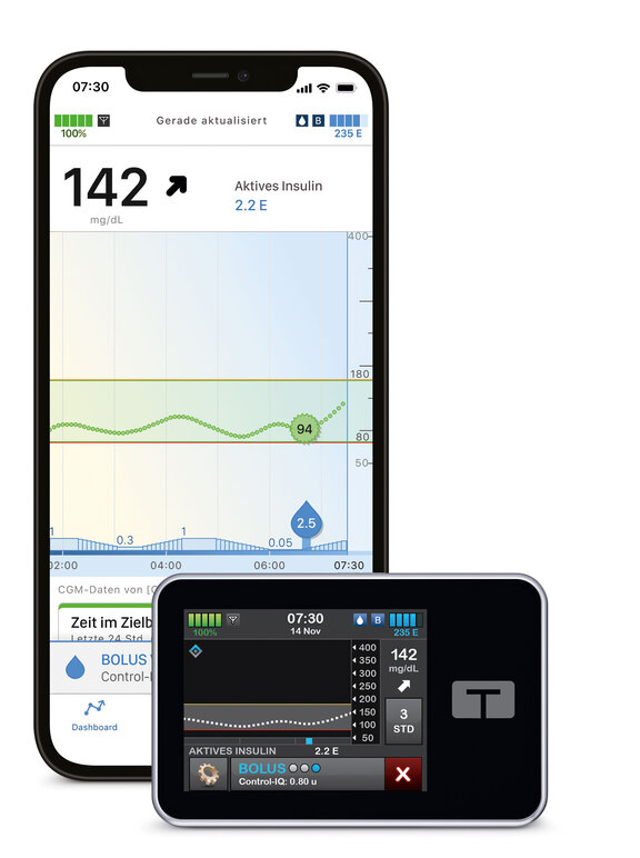 Insulinpumpe t:slim und Smartphone mit tandemt:slim Mobile App 