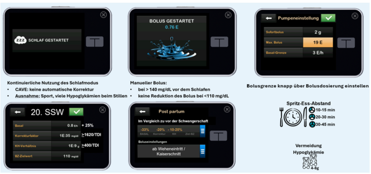 Infografik mit Empfehlungen zur Nutzung der t:slim X2 Insulinpumpe mit Control-IQ während der Schwangerschaft, inkl. Einstellungen für Schlafmodus, Bolus-Korrekturen, SSW-Anpassungen und Post-partum-Phase.