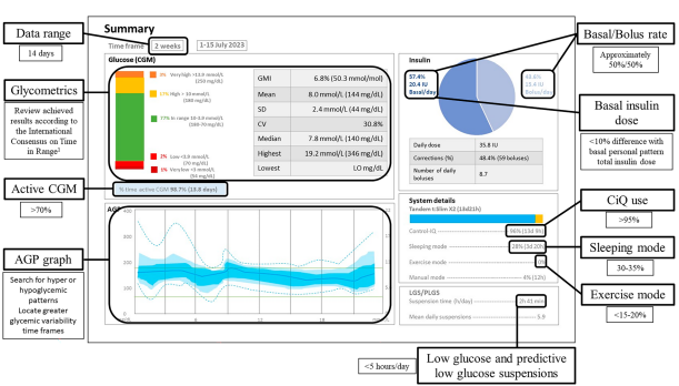 Infografik eines t:connect-Berichts (Tandem Diabetes Care) mit Erläuterungen zu den wichtigsten Parametern für einen 14-Tage-Zeitraum. Die Grafik zeigt links Glykometrie-Daten (TIR: 77 %, GMI: 6,8 %) und ein AGP-Glukoseprofil sowie rechts die Insulinverteilung (Basal/Bolus-Rate ca. 50/50) und Systemdetails zur Nutzung von Control-IQ (96 %), Schlaf- und Sportmodus sowie automatische Abschaltungen bei niedrigen Werten.